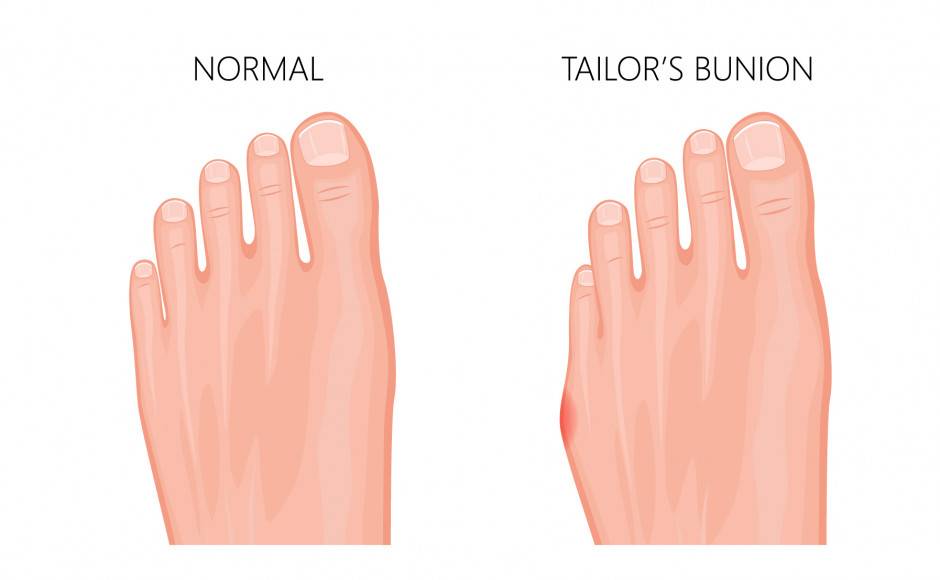 Advanced Tailor’s Bunion (Bunionette) Surgery