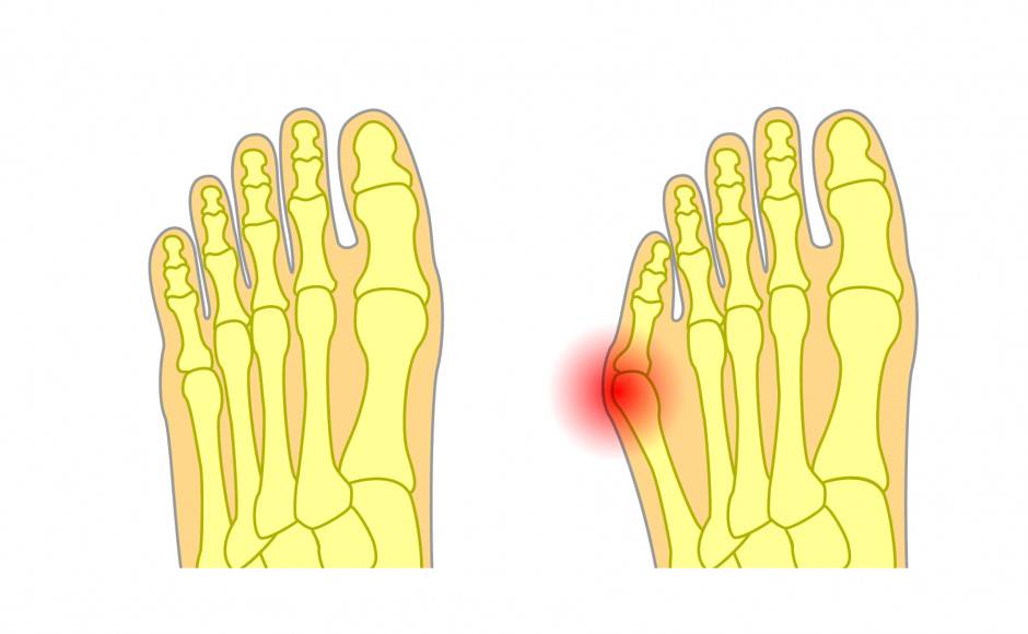 Advanced Tailor’s Bunion (Bunionette) Surgery