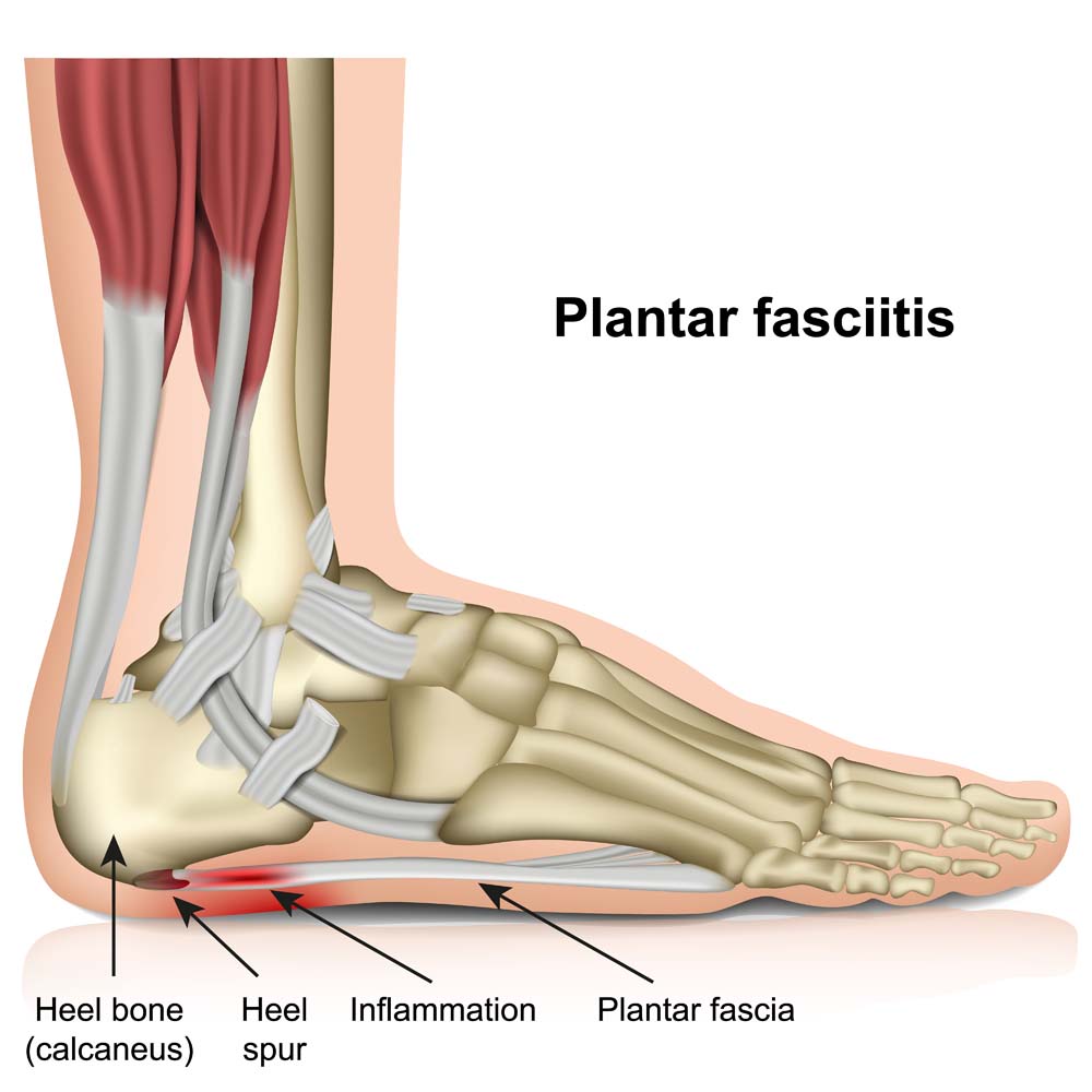 Heel spur treatment and preventive measures | Podexpert